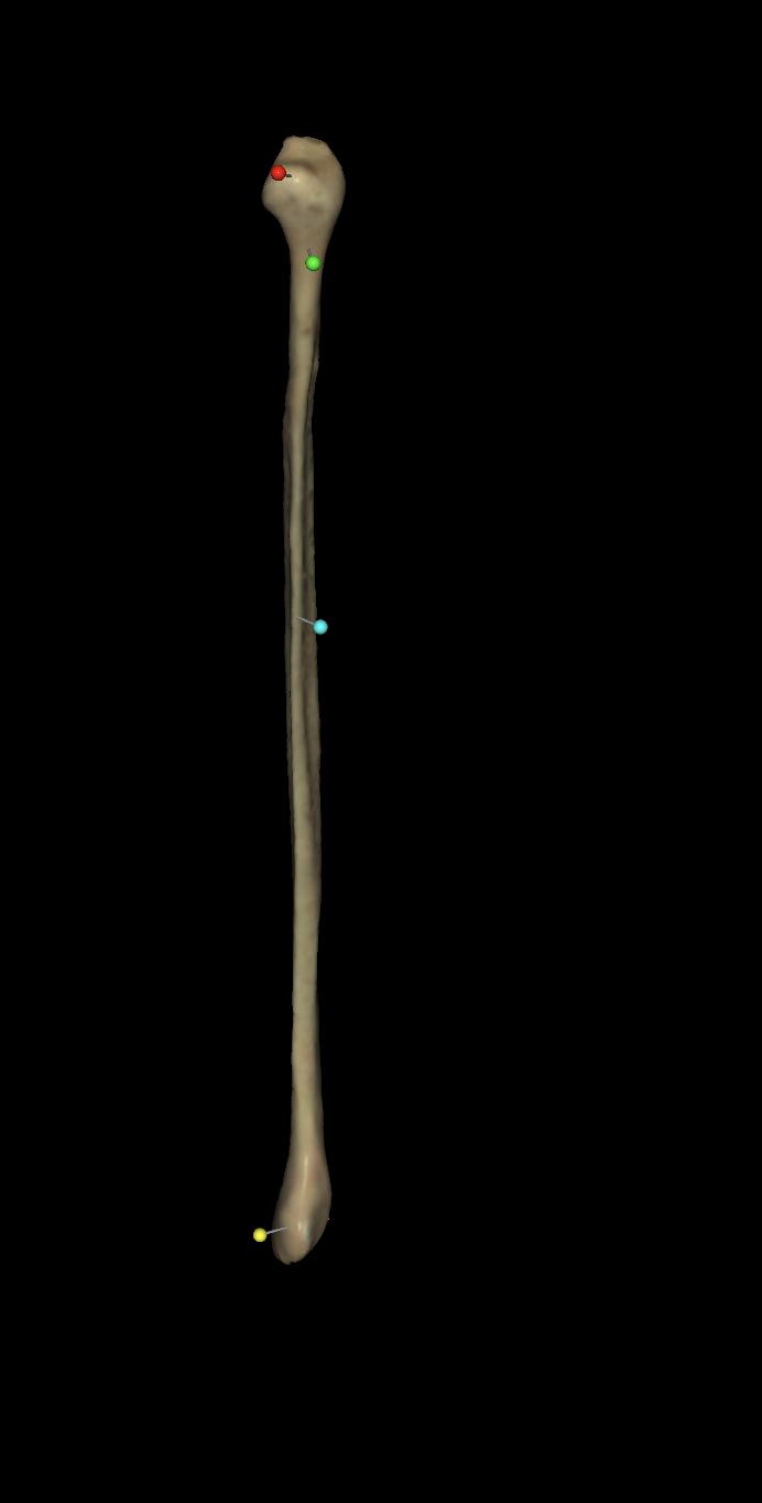 <p>On the right fibula what is the yellow tag located?</p>