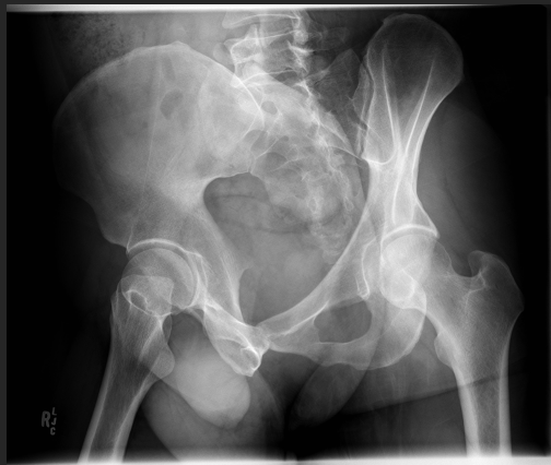 <p>Which hip is demonstrating the posterior rim?</p>