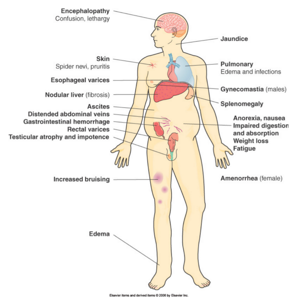 <ul><li><p><span style="background-color: transparent;">Fatty Liver</span></p><ul><li><p><span style="background-color: transparent;">Slightly enlarged</span></p></li><li><p><span style="background-color: transparent;">Pale yellow</span></p></li><li><p><span style="background-color: transparent;">Excessive build-up of fat</span></p></li><li><p><span style="background-color: transparent;">Excessive fat impacts normal cell function</span></p></li><li><p><span style="background-color: transparent;">Obesity &amp; alcoholism</span></p></li></ul></li></ul><p></p>