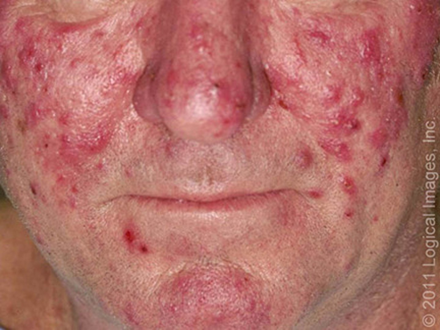 <p>Symmetric erythema of the face</p><p>Telangiectasia</p><p>Pustules and central facial edema</p>
