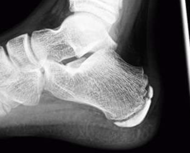 <p>AVN of the calcaneus </p>