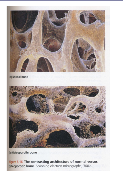 <ul><li><p>Amount of bone matrix decreases and matrix becomes more brittle (osteoporosis)</p><ul><li><p>Decreased collagen production resulting in more mineral</p></li><li><p>Rate of matrix formation by osteoblasts slower than breakdown rate by osteoclasts</p></li></ul></li><li><p>Bone loss from jaws</p><ul><li><p>Tooth loss</p></li></ul></li></ul><p></p>