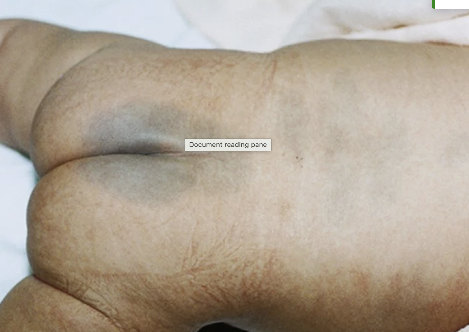 <ul><li><p>aka mongolian spot </p></li><li><p>blue/black area - not a bruise </p></li><li><p>more common on dark skin </p></li><li><p>may takes months or years to fade </p></li><li><p>usually seen on buttocks area but can be seen on arms and legs </p></li></ul><p></p>