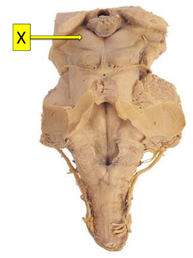 <p>Which ONE statement is true concerning structure X:</p><p>It is the superior colliculus of the tectum and it functions as a visual reflex centre.</p><p>It is the superior colliculus of the tegmentum and it functions as an auditory reflex centre.</p><p>It is the superior colliculus of the tegmentum and it functions as a visual reflex centre.</p><p>It is the superior colliculus of the tectum and it functions as an auditory reflex centre.</p><p>Is the middle cerebellar peduncle connecting the cerebellum to the pons.</p>