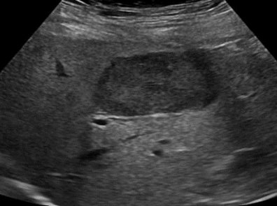 <p>PT is on BCPs, and presents with RUQ pain and palpable mass what is the diagnosis</p>