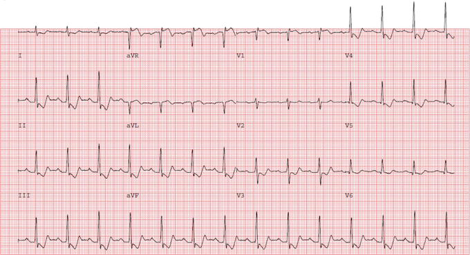 <p>Non-ST Elevation Myocardial Infarction (NSTEMI) sx</p>
