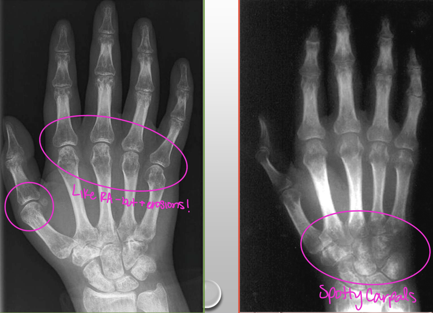 <p>What radiographic findings of Disuse osteoporosis are found in this image</p>