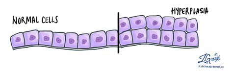 <p>An<span style="color: red;"> increase in the number of cells </span>in an organ or tissue, which may increase its volume.</p>