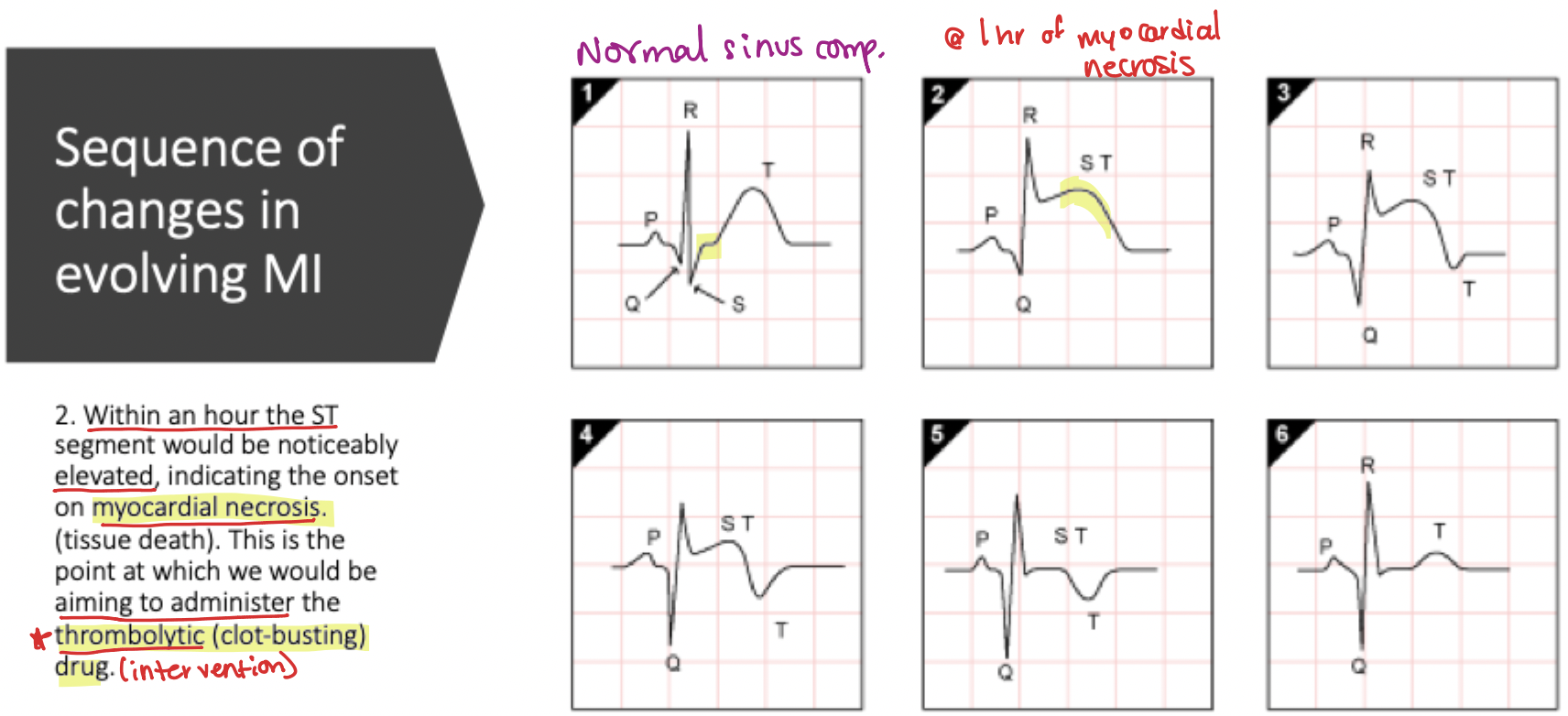 <p>Noticeable <strong>ST elevation </strong>begins; this is the primary window for <strong>thrombolytic intervention</strong></p>