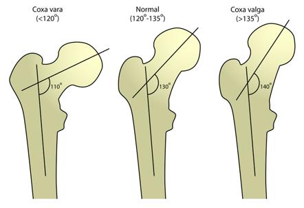 <p>Is the angle of the head/neck of the femur in relation to the shaft. Is normally between 120-130 degrees. This angle is greatest at birth and diminishes with age. Angle is less in females due to the increased width of hips and increased Q angle of the femur. </p>