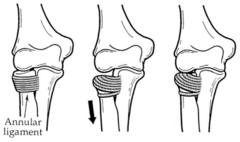<p>Subluxation of radial head, followed by entrapment of the annular ligament</p><p>Common injury in young children (birth - 6 years old)</p><p>Results from sudden pull on arm usually by a taller individual!</p>