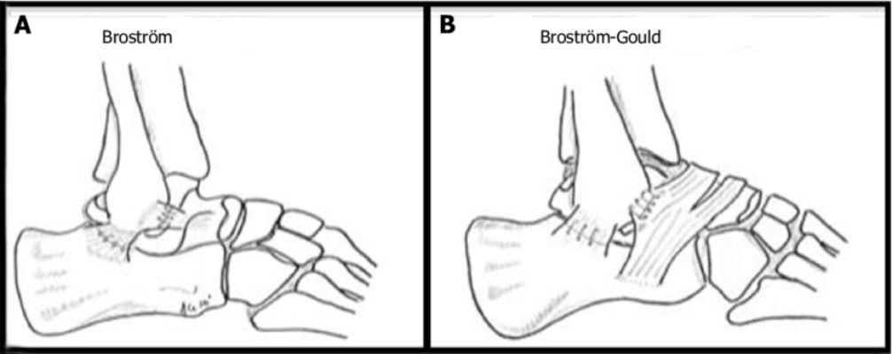 <p></p><ul><li><p>Another type of <strong>Stabilization Surgery </strong>for <strong>Chronic Ankle Instability</strong></p></li><li><p>Exact same thing as Brostrum Repair <strong><em><u>but</u></em></strong> the <strong>extensor retinaculum</strong> is <strong>flipped over</strong> to provide extra lateral instability</p></li></ul><p></p>