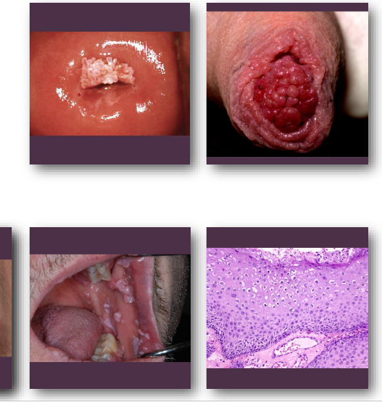 <p><strong>•Sessile, pink exophytic mass with broad base</strong></p><p>•Surface shows blunted papillary projections</p><p>•Often larger than papilloma and clustered</p><p>•Color ranges from <strong>pink to white or gray</strong></p><p>•<strong>Common on labial mucosa and lingual frenum</strong></p><p></p>