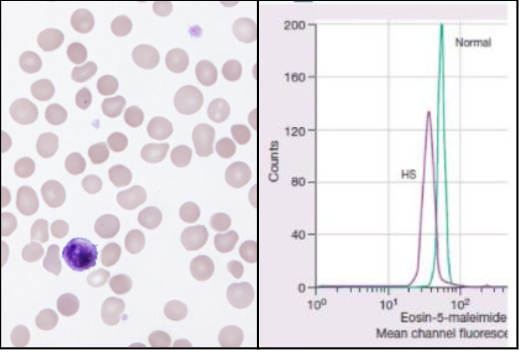 <p>Hereditary Spherocytosis Lab Features and Treatment</p>