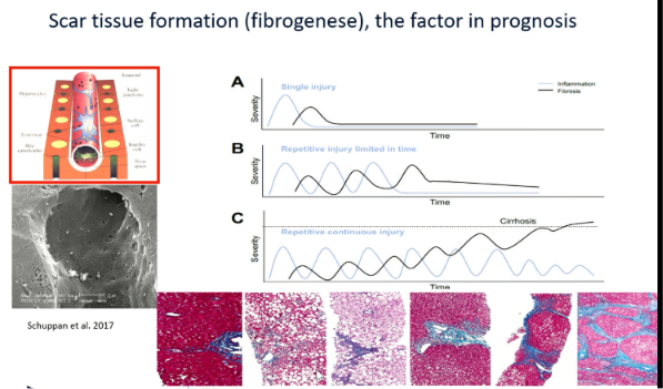 <p>Fibrosis develops following repeated liver injury.</p><p>The process involves:</p><ul><li><p>Chronic hepatocyte injury.</p></li><li><p>Activation of <strong>hepatic stellate cells</strong>.</p></li><li><p>Transformation into collagen-producing myofibroblasts.</p></li><li><p>Progressive deposition of connective tissue.</p></li><li><p>Development of cirrhosis if injury continues.</p></li></ul><p></p>