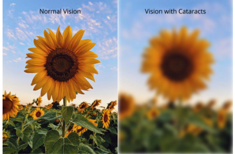 <p>blurred vision, lack of visual acuity </p>