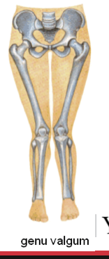 <p>Knock-knees, where the knees touch while the ankles remain apart.</p>