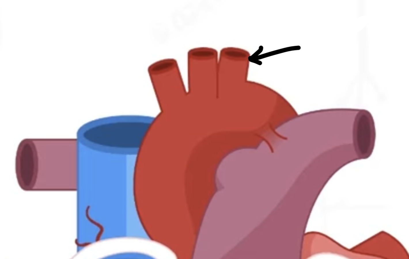 <p>left-most vessel on the aortic arch</p>