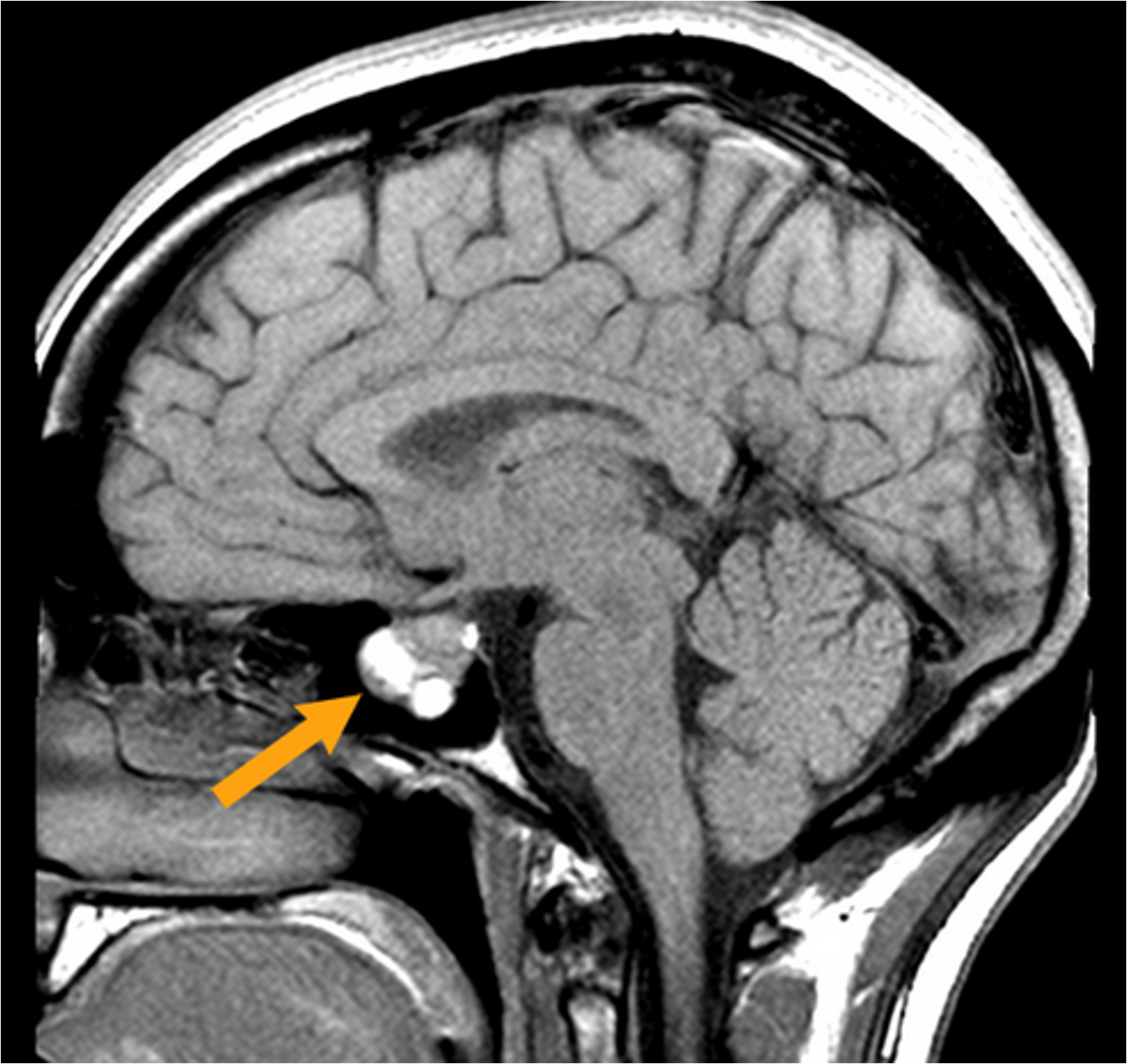 <ul><li><p>A <strong>functional pituitary adenoma</strong> is a <strong>benign (non-cancerous) tumor</strong> of the pituitary gland.</p></li><li><p><strong>“Functional”</strong> means it <strong>increases hormone production</strong>, unlike non-functional tumors which are just masses.</p></li><li><p>Can affect <strong>endocrine function</strong>, causing symptoms related to <strong>overproduction of pituitary hormones</strong>.</p></li><li><p>Even though it does not spread, it can impact <strong>brain function and hormone balance</strong>.</p></li></ul><p></p>