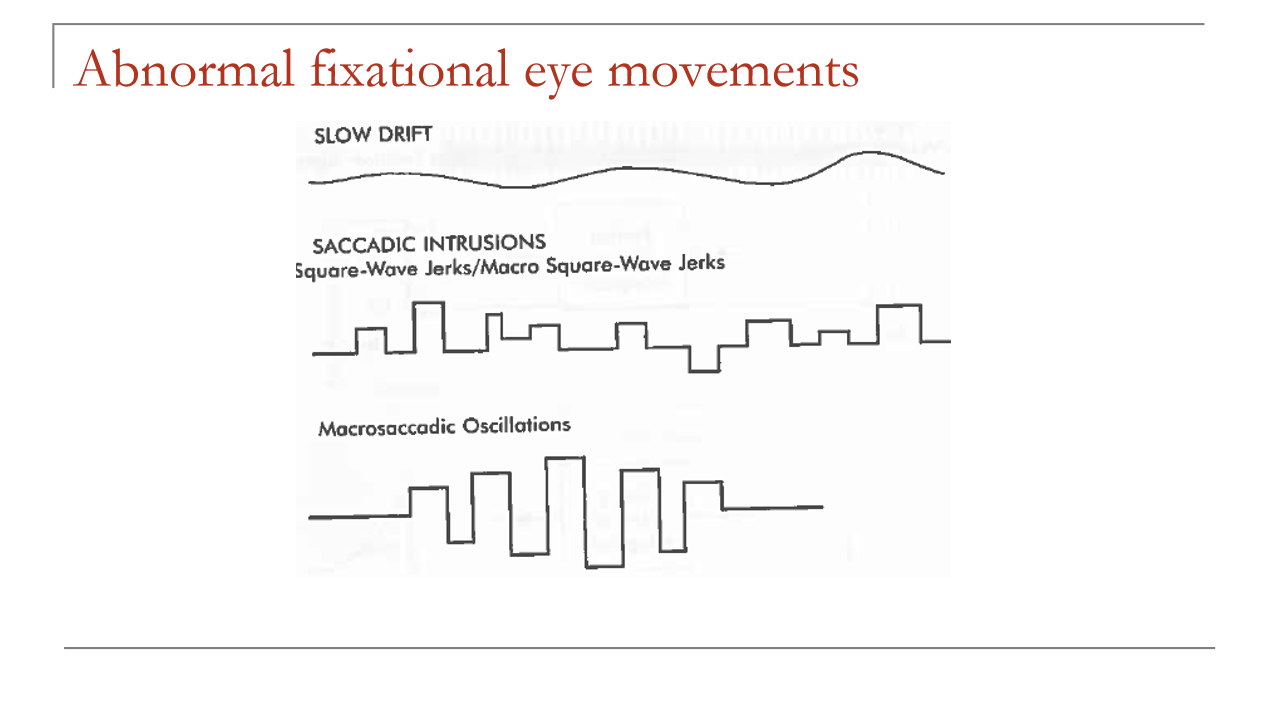 <ul><li><p>A sequence of saccades to either side of fixation</p></li><li><p>Amplitude first increases, then decreases</p></li><li><p>Represents an abnormal oscillation around the fixation point</p></li></ul><p></p>