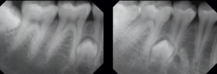 <p>Evaluate the position of the impacted premolar.</p>