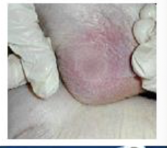<p>Non-blanchable erythema</p>