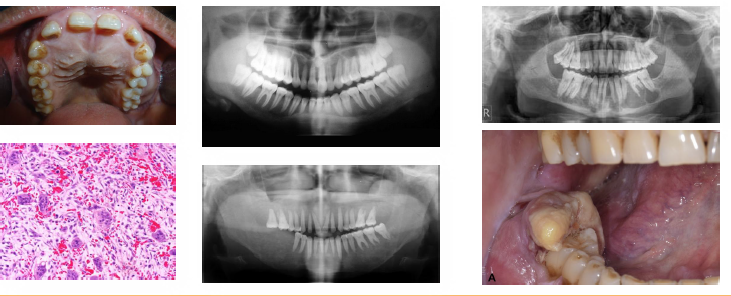 <p><strong>•"Stones bones groans" classic symptom pattern</strong></p><p><strong>•Renal stones due to hypercalcemia levels</strong></p><p><strong>•Ground glass bone with lamina dura loss</strong></p><p>•Brown tumors cause jaw radiolucencies</p><p>•Bone and root resorption may be evident</p><p></p>