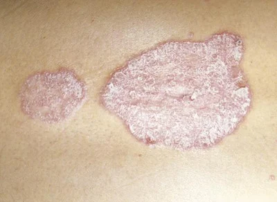 <p>Lichenification</p>