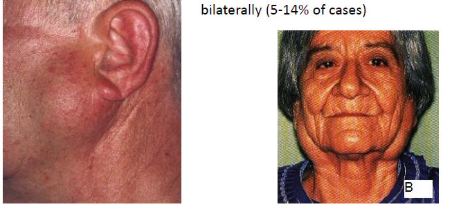 <p>warthin tumor (papillary cystadenoma lymphomatosum) clinical features</p>