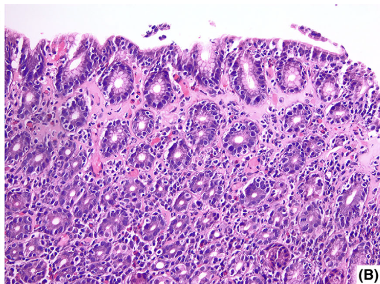 <p>1) Diagnostic </p><p>2) différence avec gastrite atrophique (d’un point de vue de l’atrophie) </p><p>3) association</p>