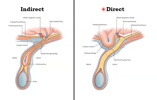 <ul><li><p>indirect</p><ul><li><p>abdominal organs push through the inguinal canal weakening</p></li></ul></li><li><p>direct</p><ul><li><p>abdominal organs push the anterior abdominal wall </p></li></ul></li></ul><p></p>