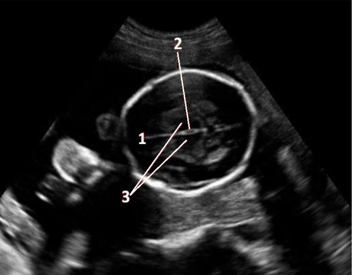 <p>What fetal structure is indicated by #1?</p><p>A. falx cerebri</p><p class="p1">B. cisterna magna</p><p class="p1">C. caudate nucleus</p><p class="p1">D. corpus callosum</p>
