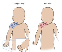 <p>A type of paralysis affecting the hand and wrist due to injury to the lower group of arm nerves.</p>