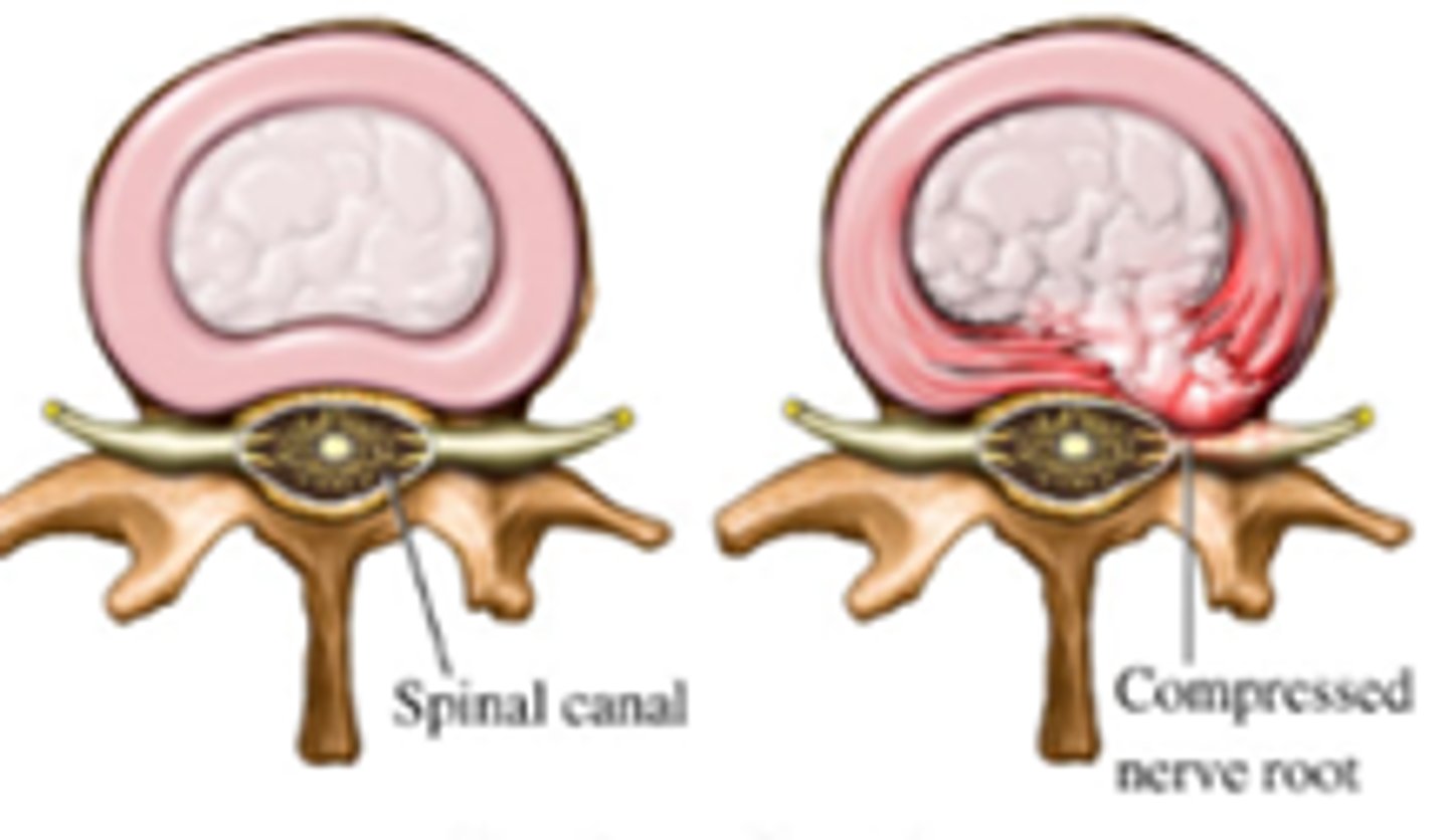 <p>small intestine protrudes from where it should be</p>