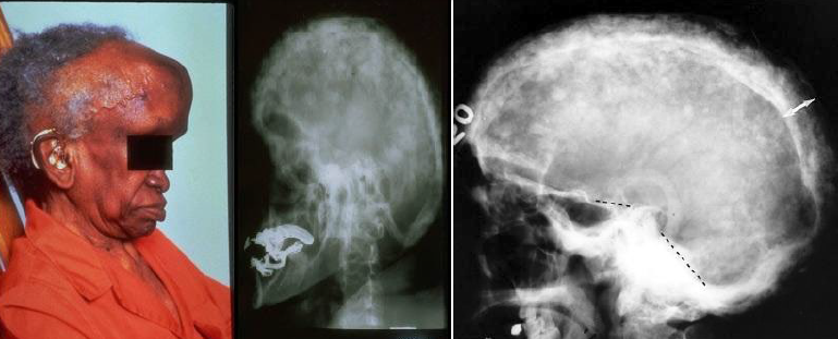 <p>cotton-wool appearance</p>