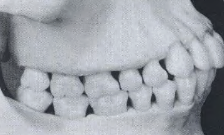 <p>What is the term for triangular shaped space between the teeth normally filled with gingival tissue? </p>