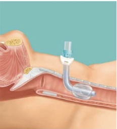 <p>Tracheostomy tube indications</p>