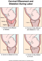 <p>- thinning and shortening of the cervix</p><p>- must be 100% effaced for delivery</p>