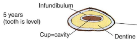 <p>Red - Infundibulum</p><p>Right orange - Dentine</p><p>Left orange - Cup</p><p></p><p>5yrs</p>