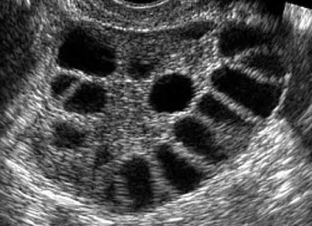<p>Patient presents w/hirsutism and amenorrhea. Dx?</p><p>a. PID</p><p>b. Endometriosis</p><p>c. OHSS</p><p>d. PCOS</p>