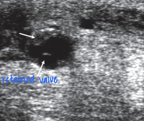 <ul><li><p>valve remnants that remain due to incomplete valve removal</p></li><li><p>larger remnants → stenosis</p></li><li><p><em>bright</em> echoes</p></li></ul><p></p>