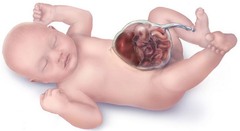 <p>At six to ten weeks of embryonic development, a fetus's intestines will herniate into the umbilical cord. The fetus's abdomen will grow, and then the intestines will return to the abdomen at ten or eleven weeks. An omphalocele occurs when the intestines do not return and instead remain outside of the abdomen. In contrast to gastroschisis, omphaloceles are covered with a membrane.</p>