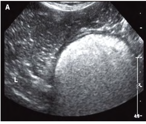 <p>what does the following ultrasound show?</p>
