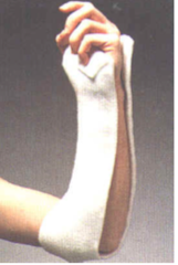 <p>sugar tong splint</p><p>sling</p>