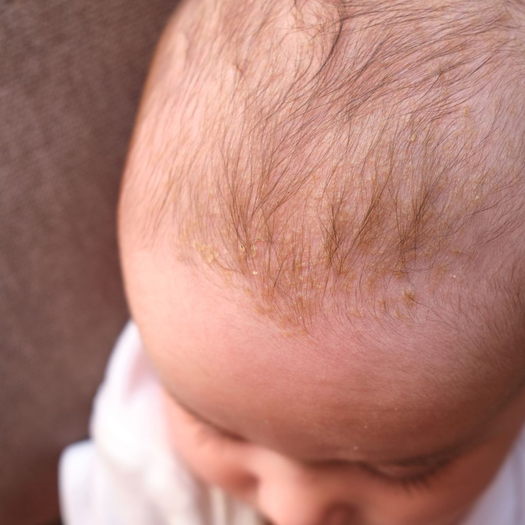 <p>seborrheic dermatitis</p>