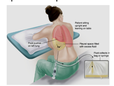 <p><span style="background-color: transparent;">Thoracocentesis</span></p><p></p>