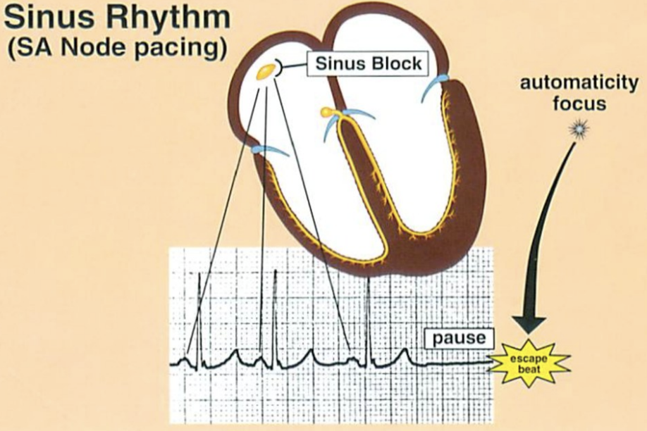 <p>a missed/dropped beat, pause…ODS lost, then allows for an escape</p>