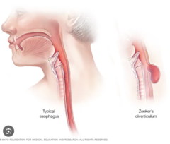 <p>zenker's diverticulum (diverticulum= outpouching) is located in the poZterior of the upper esophagus due to killlian's triangle, and increases risk for Zquamous cell carcinoma</p>