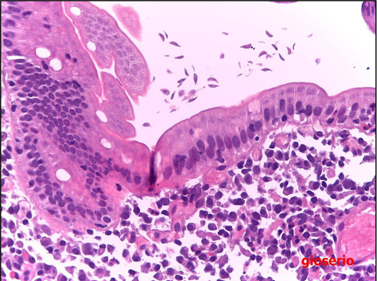 <p>a) F. Protozoário fica aderido às células do epitélio, impedindo a absorção de nutrientes <br>b) F. restrita ao ID<br>c) F. cisto que é, libera trofozoíto já no ID</p>