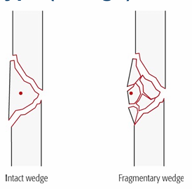 <p>a triangular piece of bone is created, usually because the bone has been <strong>compressed from one side</strong>; wedge may be intact or fragmentary</p>